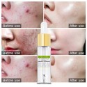 Ser tratament acnee cu tea-tree si colagen, Vibrant Glamour Tea Tree Acne Treatment Serum 15 ml 